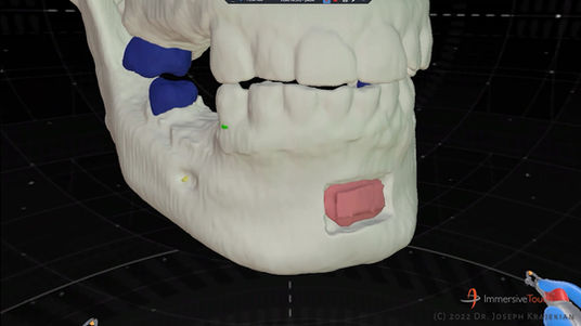 Chin bone graft